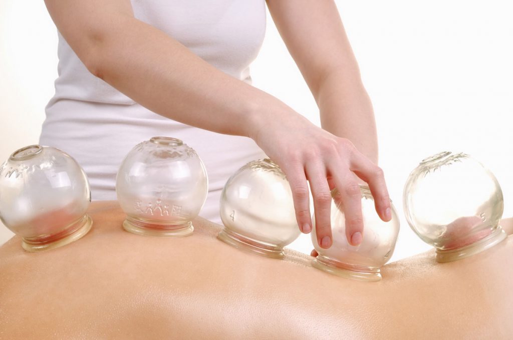 Cupping Therapy | Health Center Acupuncture | Mount Vernon, OH